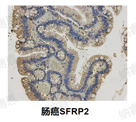 肠癌SFRP2.png