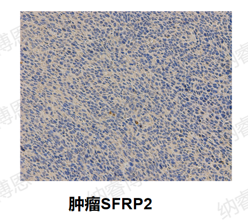 肿瘤SFRP2.png